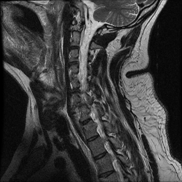 File:Cervical fracture and dislocation with locked facet (Radiopaedia 31837-32781 Sagittal T2 11).jpg