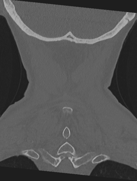 File:Cervical spondylolysis (Radiopaedia 49616-54811 Coronal bone window 53).png