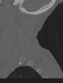 Cervical spondylolysis (Radiopaedia 49616-54811 Sagittal bone window 64).png