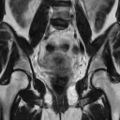 Cesarian section scar endometriosis (Radiopaedia 66520-75799 Coronal T2 19).jpg