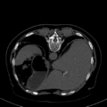 Cholecystitis - CT IVC obstructive choledocholitiasis (Radiopaedia 43966-47479 Axial Biliscopin 27).png