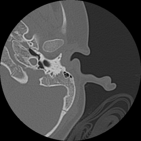 File:Cholesteatoma (Radiopaedia 73023-83750 Axial Left ear 13).jpg