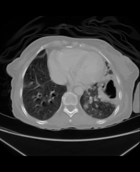File:Chondrosarcoma (Radiopaedia 79427-92535 Axial lung window 38).jpg