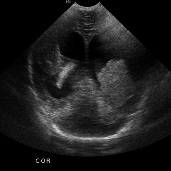 File:Choroid plexus carcinoma (Radiopaedia 21121-21033 A 6).jpg