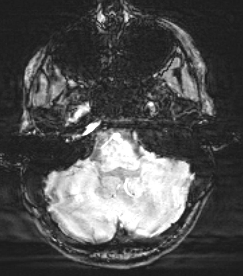 Choroid plexus carcinoma (Radiopaedia 91013-108553 Axial SWI 20).jpg