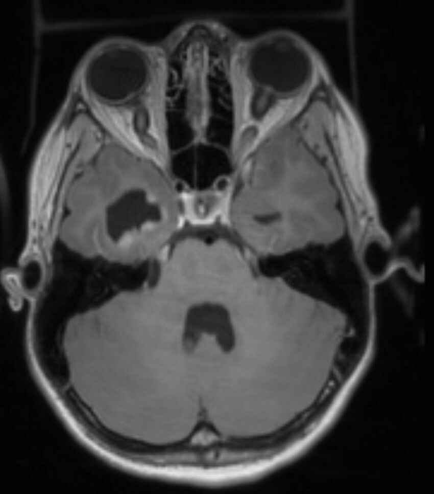 Choroid plexus carcinoma (Radiopaedia 91013-108553 Axial T1 C+ 102).jpg