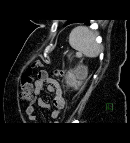 File:Chromophobe renal cell carcinoma (Radiopaedia 84239-99519 D 23).jpg