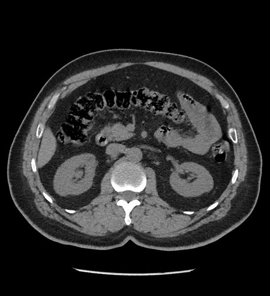 File:Chromophobe renal cell carcinoma (Radiopaedia 86879-103083 Axial non-contrast 37).jpg
