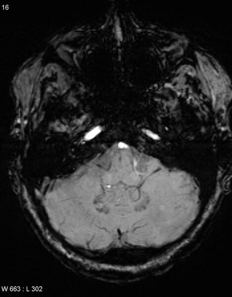File:Chronic lymphocytic inflammation with pontine perivascular enhancement responsive to steroids (CLIPPERS) (Radiopaedia 37520-39374 Axial SWI 15).jpg