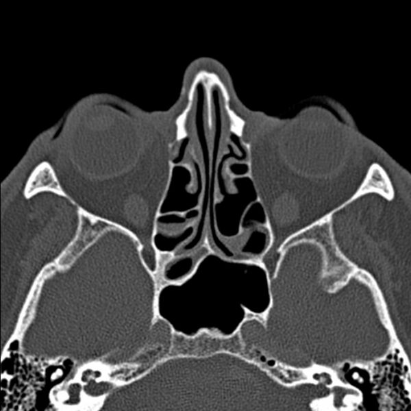 File:Chronic maxillary sinusitis (Radiopaedia 27879-28116 Axial bone window 30).jpg
