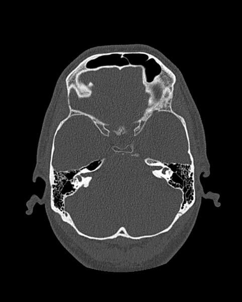 File:Chronic maxillary sinusitis caused by a foreign body (Radiopaedia 58521-65676 Axial bone window 260).jpg