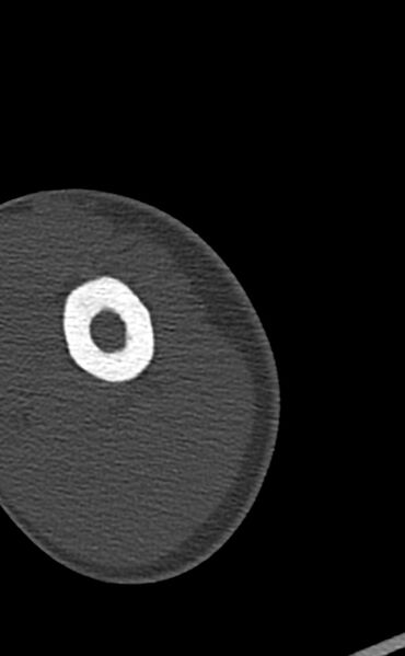 File:Chronic osteomyelitis of the distal humerus (Radiopaedia 78351-90971 Axial bone window 17).jpg