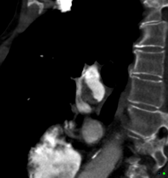 File:Chronic pulmonary embolism (Radiopaedia 17943-17702 Sagittal C+ CTPA 36).jpg