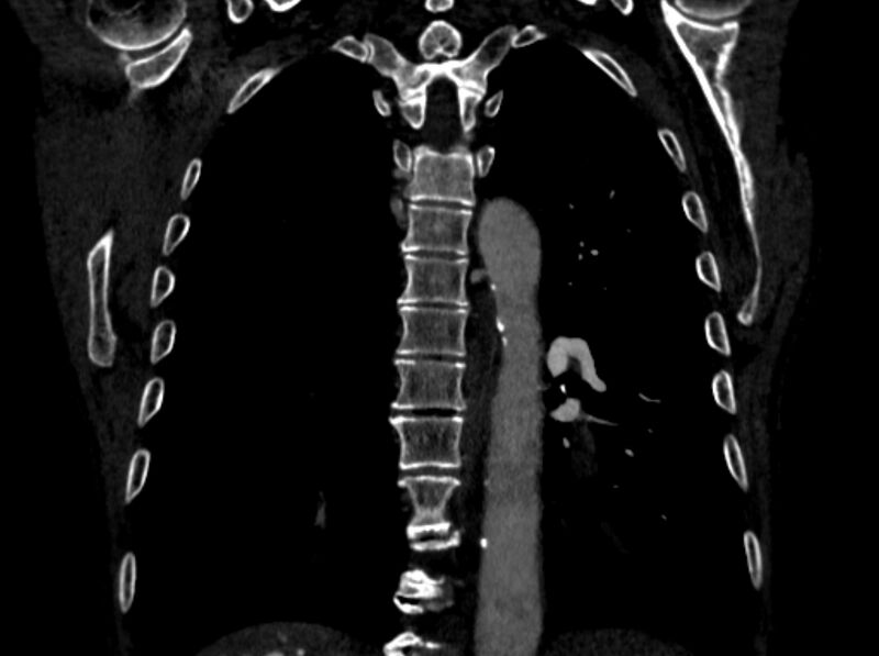 File:Chronic pulmonary embolism (Radiopaedia 91241-108843 A 78).jpg