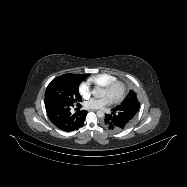 File:Chronic thromboembolic pulmonary hypertension (CTEPH) (Radiopaedia 74597-85532 Axial C+ CTPA 79).jpg