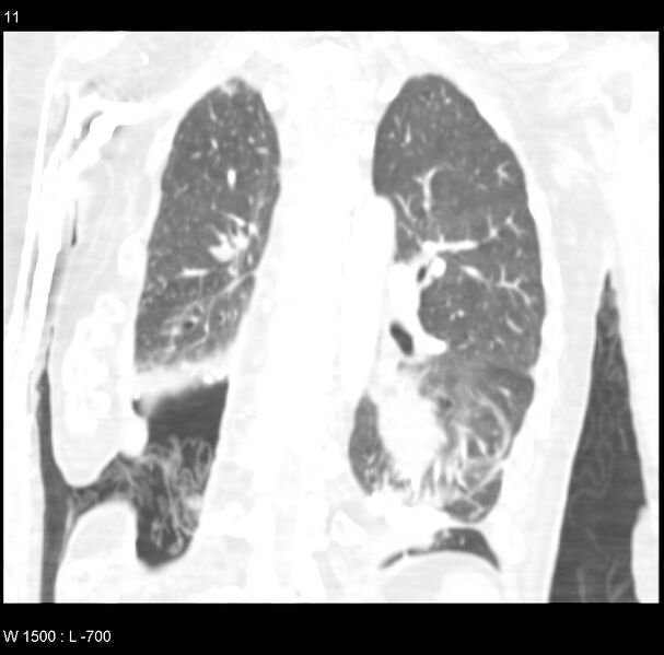File:Clagett thoracotomy (Radiopaedia 8568-9403 Coronal lung window 11).jpg