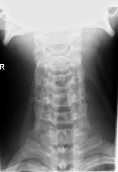 File:Clay-shoveler fracture (Radiopaedia 33847-35012 Frontal 1).png