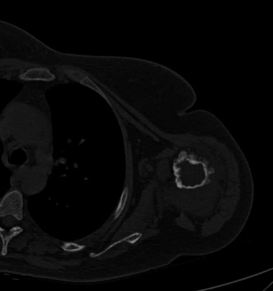 File:Clear cell chondrosarcoma - humerus (Radiopaedia 63104-71612 Axial bone window 62).jpg