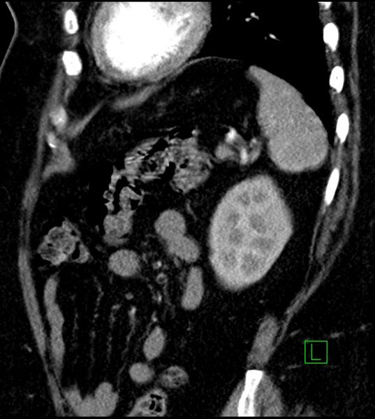 File:Clear cell renal cell carcinoma (Radiopaedia 85004-100537 D 16).jpg