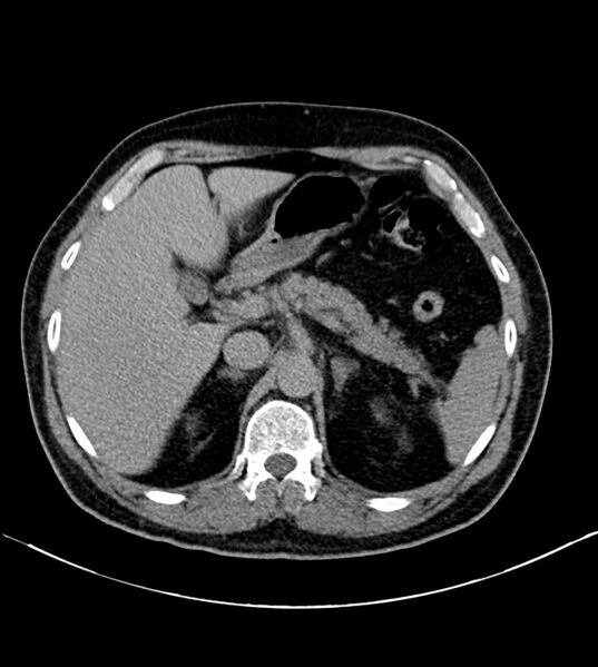 File:Clear cell renal cell carcinoma (Radiopaedia 85006-100539 H 5).jpg