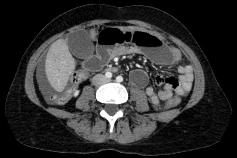 File:Closed loop small bowel obstruction (Radiopaedia 71211-81508 A 67).jpg