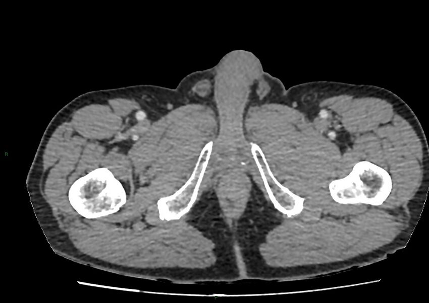 Closed loop small bowel obstruction with ischemia (Radiopaedia 84180-99456 A 132).jpg