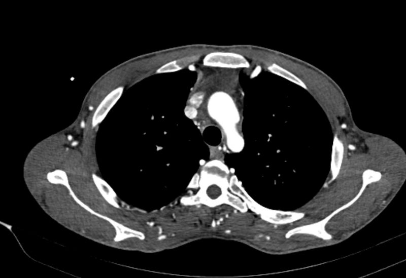 File:Coarctation of aorta with aortic valve stenosis (Radiopaedia 70463-80574 A 29).jpg