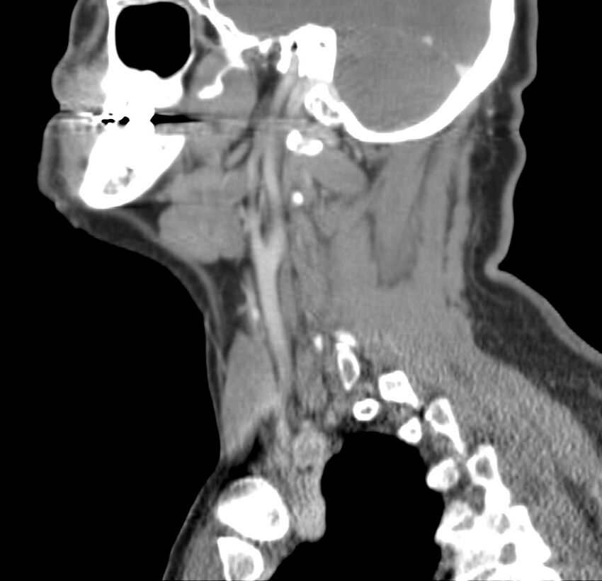 Colloid cyst of thyroid (Radiopaedia 22897-22923 Sagittal C+ delayed 21).jpg
