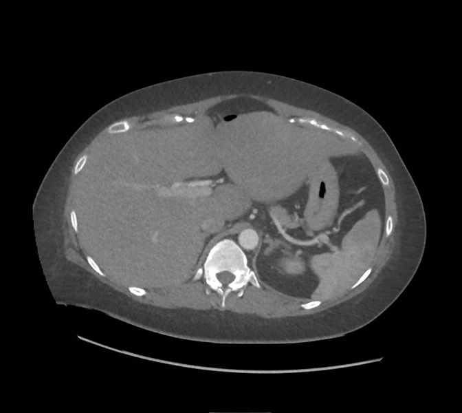 File:Colonic pseudo-obstruction (Radiopaedia 79752-92980 A 46).png