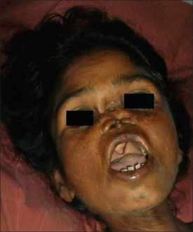 Late onset: Deformity of nose and palate