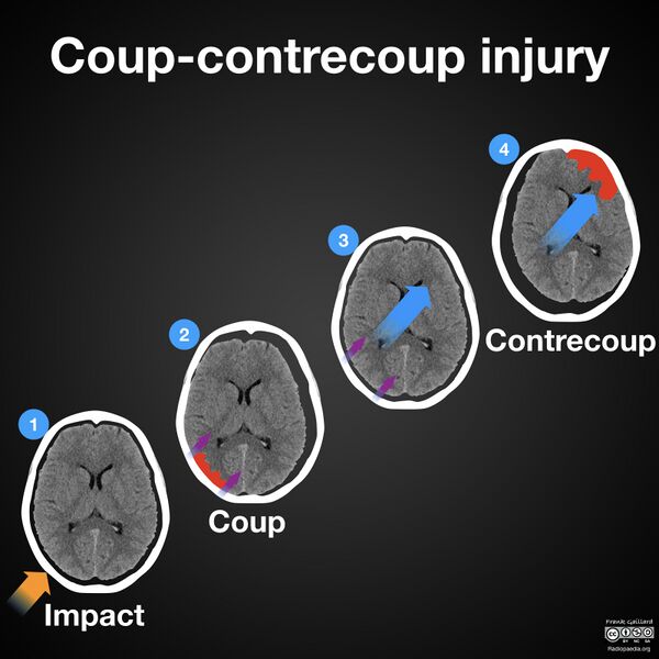 File:Coup-contrecoup injury (diagram) (Radiopaedia 55561).jpeg