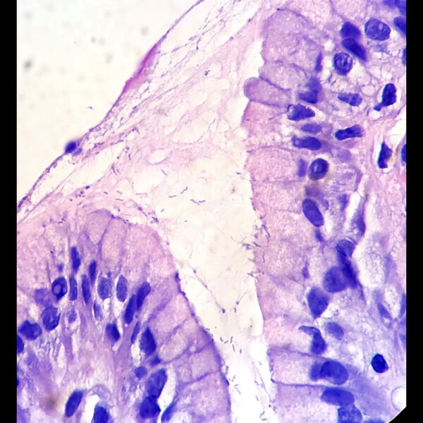File:Helicobacter pylori (histology) (Radiopaedia 77563).jpeg