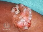 Macro image of chromoblastomycosis (DermNet NZ chromoblastomycosis-01).jpg