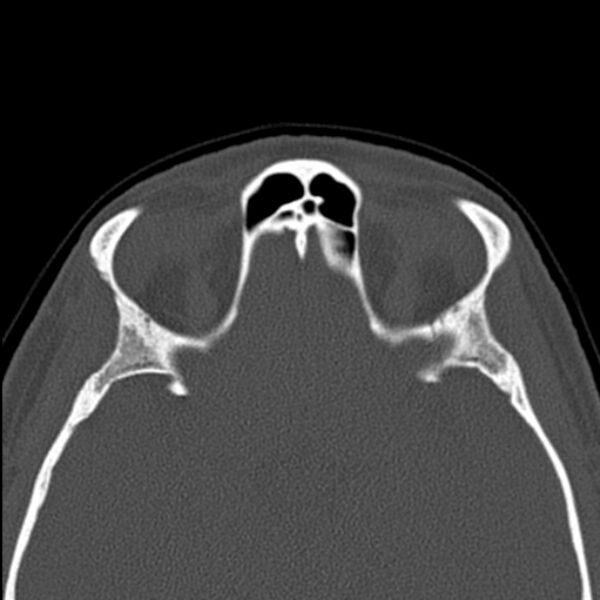 File:Nasal septal perforation (Radiopaedia 25030-25289 Axial bone window 54).jpg