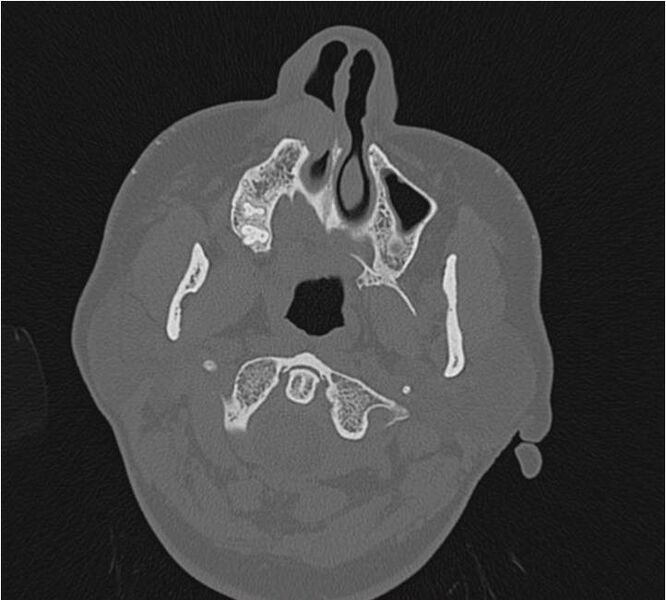 File:Nasolabial cyst (Radiopaedia 25322-25580 Axial bone window 4).jpg