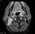 Nasopharyngeal carcinoma (Radiopaedia 4546-6667 Axial T1 C+ fat sat 17).jpg