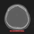 Nasopharyngeal carcinoma recurrence - skull base destruction (Radiopaedia 29107-29490 Axial bone window 28).jpg