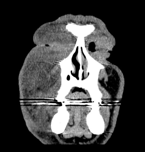 File:Necrobiotic xanthogranuloma- face (Radiopaedia 29549-30052 A 3).jpg