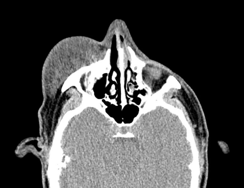 File:Necrobiotic xanthogranuloma- face (Radiopaedia 29549-30052 Axial C+ delayed 6).jpg