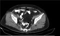 Necrotizing pancreatitis (Radiopaedia 20595-20495 Axial C+ delayed 39).jpg