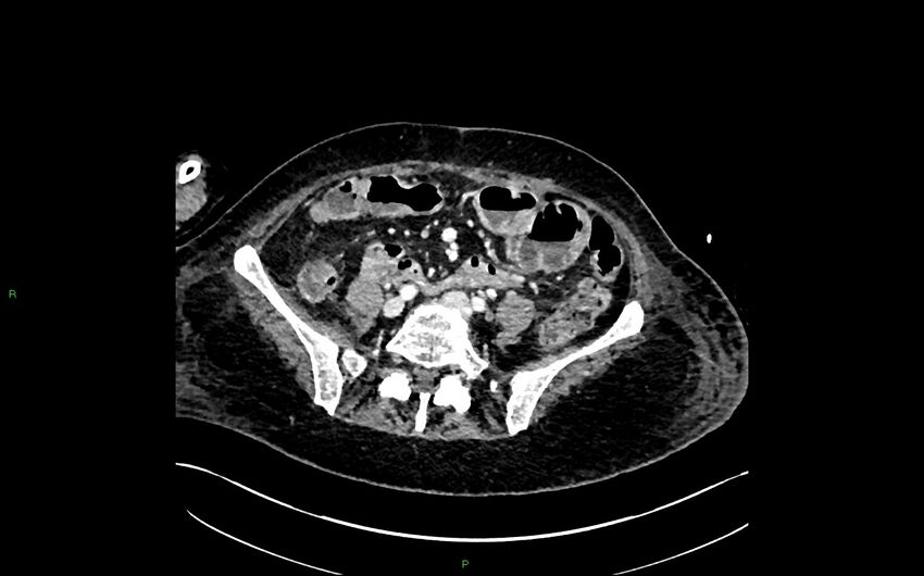 Neo-terminal ileal stricture (Crohn disease) (Radiopaedia 33790-34948 A 312).jpg