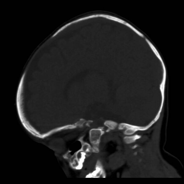 File:Neuroblastoma with skull metastases (Radiopaedia 30326-30958 Sagittal bone window 25).jpg