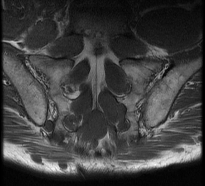 File:Neurofibromatosis type 1 (Radiopaedia 11671-12034 Coronal 2).jpg