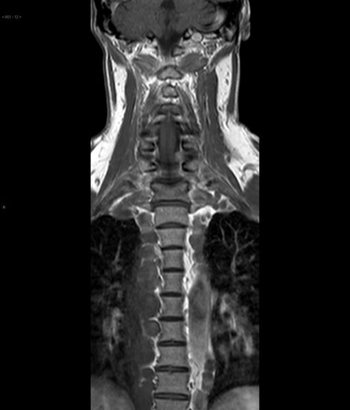 File:Neurofibromatosis type 1 (Radiopaedia 36933-38560 Coronal T1 12).jpg