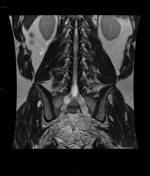 File:Neurofibromatosis type 1 (Radiopaedia 36933-38560 Coronal T2 13).jpg