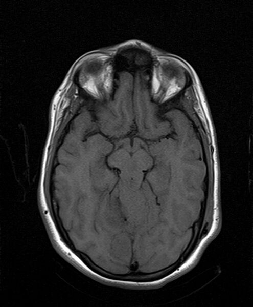 File:Neurofibromatosis type 2 (Radiopaedia 66211-75401 Axial T1 14).jpg