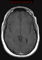 Neuroglial cyst (Radiopaedia 10713-11184 Axial T1 12).jpg