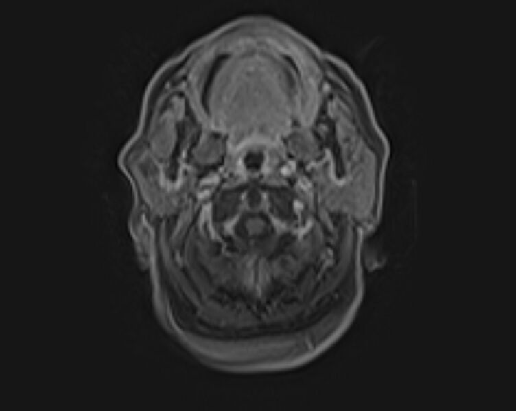 File:Non-Hodgkin lymphoma - parotid gland (Radiopaedia 71531-81890 E 40).jpg