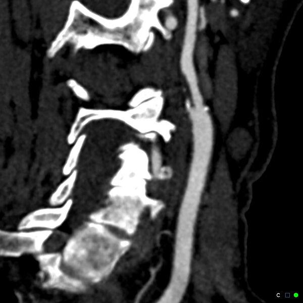 File:Non-occlusive intraluminal internal carotid artery thrombus (Radiopaedia 37751-39658 C 8).jpg