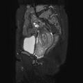 Non-puerperal uterine inversion (Radiopaedia 78343-90983 Sagittal T2 fat sat 11).jpg